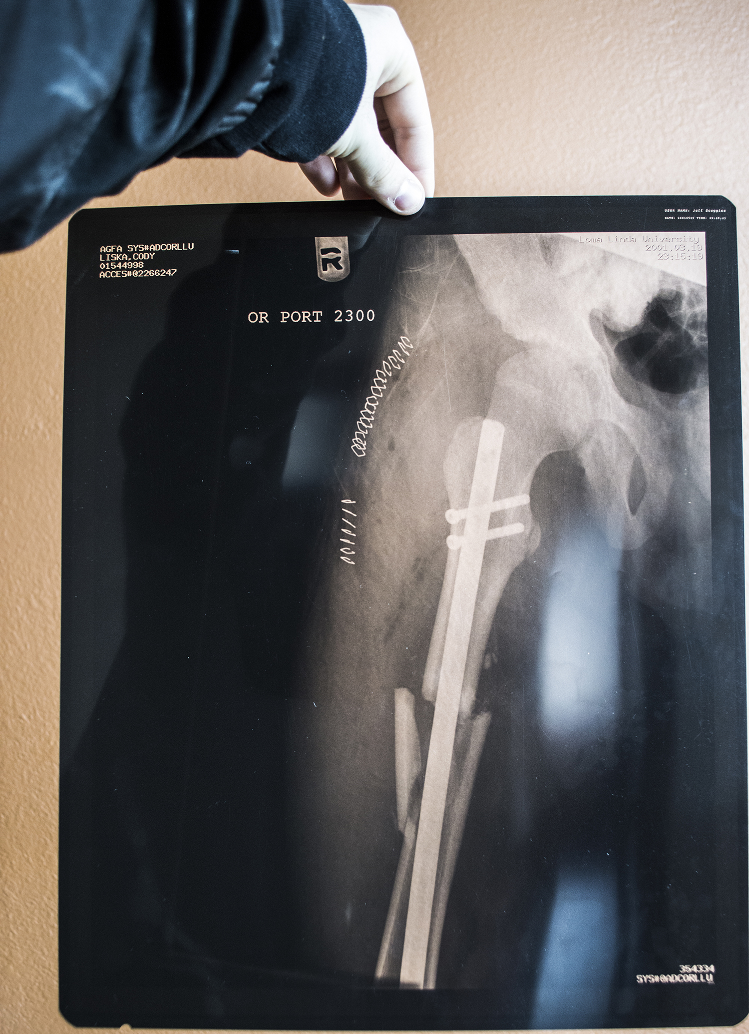 Femur_xray.jpg